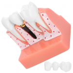 Hammaste mudel Hambaimplantaadi anal&uuml;&uuml;s Kroonsilla mudeli demonstratsioon hambamudel