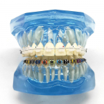 1 tk hambaortodontiline mudel Patsiendiga suhtlemine 2 t&uuml;&uuml;pi kronsteinid koos kaarjuhtmetega ligatuurid Keraamiline kronstein, metallist servakujuline klamber 1 piece Clear puhas