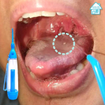 Pickout suukaudne v&otilde;&otilde;rkeha eemaldaja kurgu kaka eemaldamise meetod inhalaator sinine, 1 tk