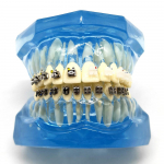 1 tk hambaortodontiline mudelpatsientide suhtlemine 4 t&uuml;&uuml;pi klambrid keraamilise kronsteiniga Metallist iseligeeruvad klambrid 1 piece A sinine