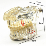 1 tk hambaimplantaadi haiguse hammaste mudel taastava sildhambaga hambaarstiga meditsiiniteaduse jaoks hambahaiguste &otilde;petamise uuring 1 piece clear