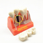 1 t&uuml;kk 4 korda Hambahammaste &otilde;petamise uuring Hambaimplantaadi haiguse anal&uuml;&uuml;si mudel koos restaureerimise kroonsilla demonstratsiooniga 1 piece Red