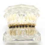 1 tk hambaortodontiline l&auml;bipaistev hammaste mudel tavaliste keraamiliste ja metallist klambrite ja komplektidega patsientide suhtlemiseks 1 piece Clear