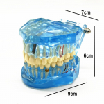 1 tk hambaimplantaadi haiguse hammaste mudel taastava sildhambaga hambaarstiga meditsiiniteaduse jaoks hambahaiguste &otilde;petamise uuring 1 piece A