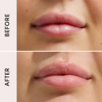 Lip Filler Plumping Effect