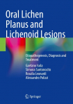 Oral Lichen Planus and Lichenoid Lesions: Etiopathogenesis, Diagnosis and Treatment